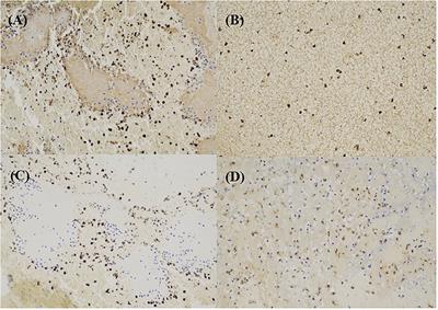 High Actin Expression in Thrombus of Acute Ischemic Stroke Can Be a Biomarker of Atherothrombotic Origin Stroke